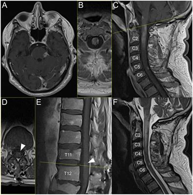 Recurrent Acute Disseminated Encephalomyelitis (ADEM) after COVID-19-vaccination and after subsequent COVID-19-infection: A case report (part II)